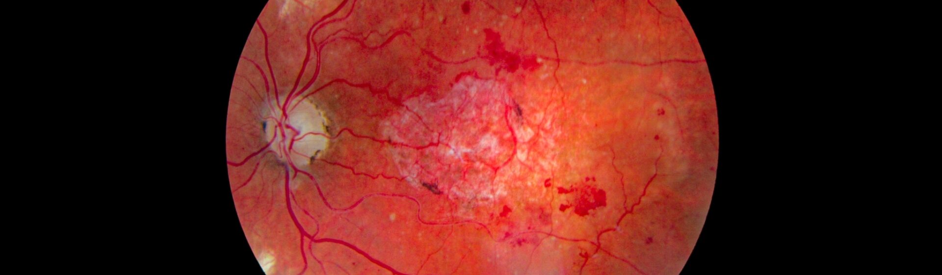 Common eye Conditions