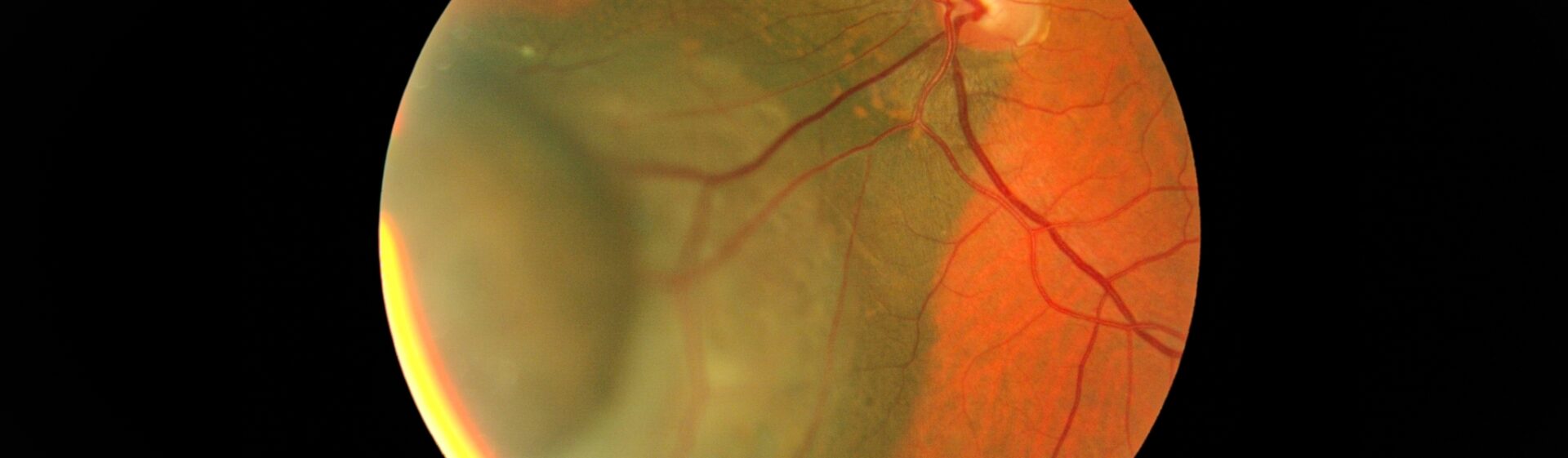Eye emergency
